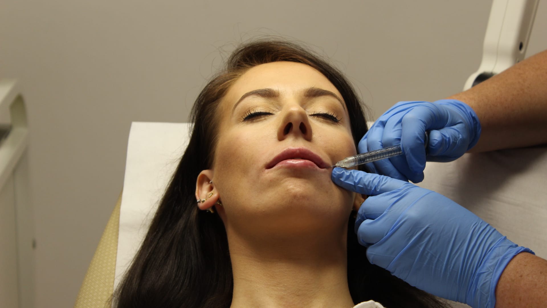 lip fillers glasgow transform clinic