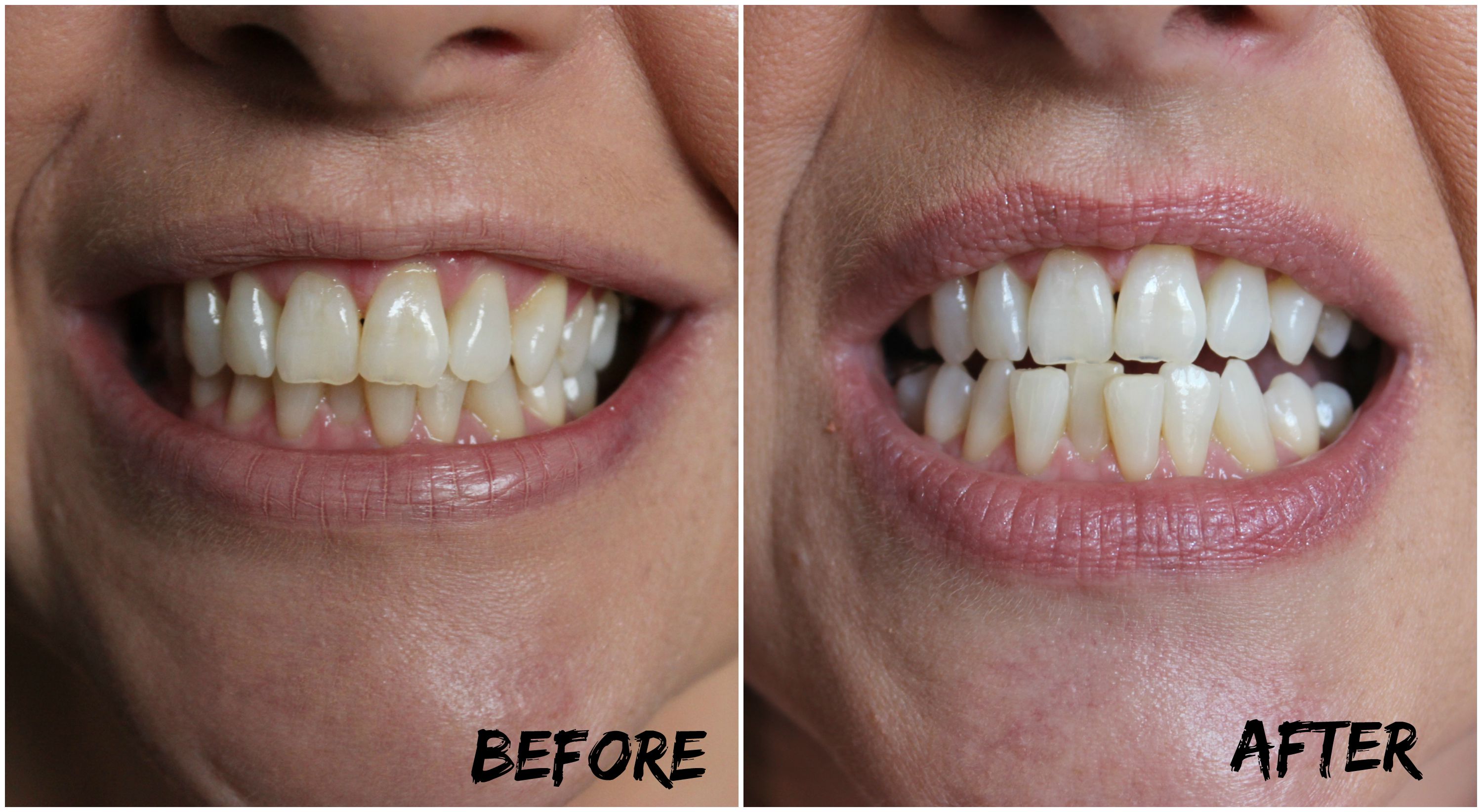 easy way to whiten teeth at home