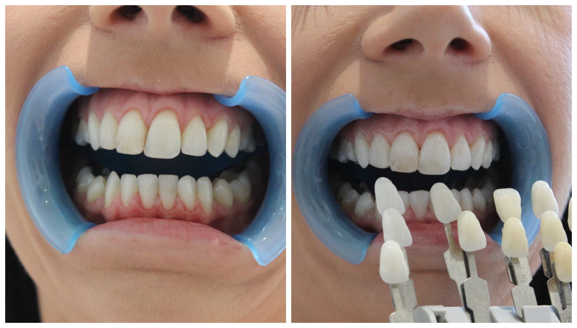 before and after laser teeth whitening