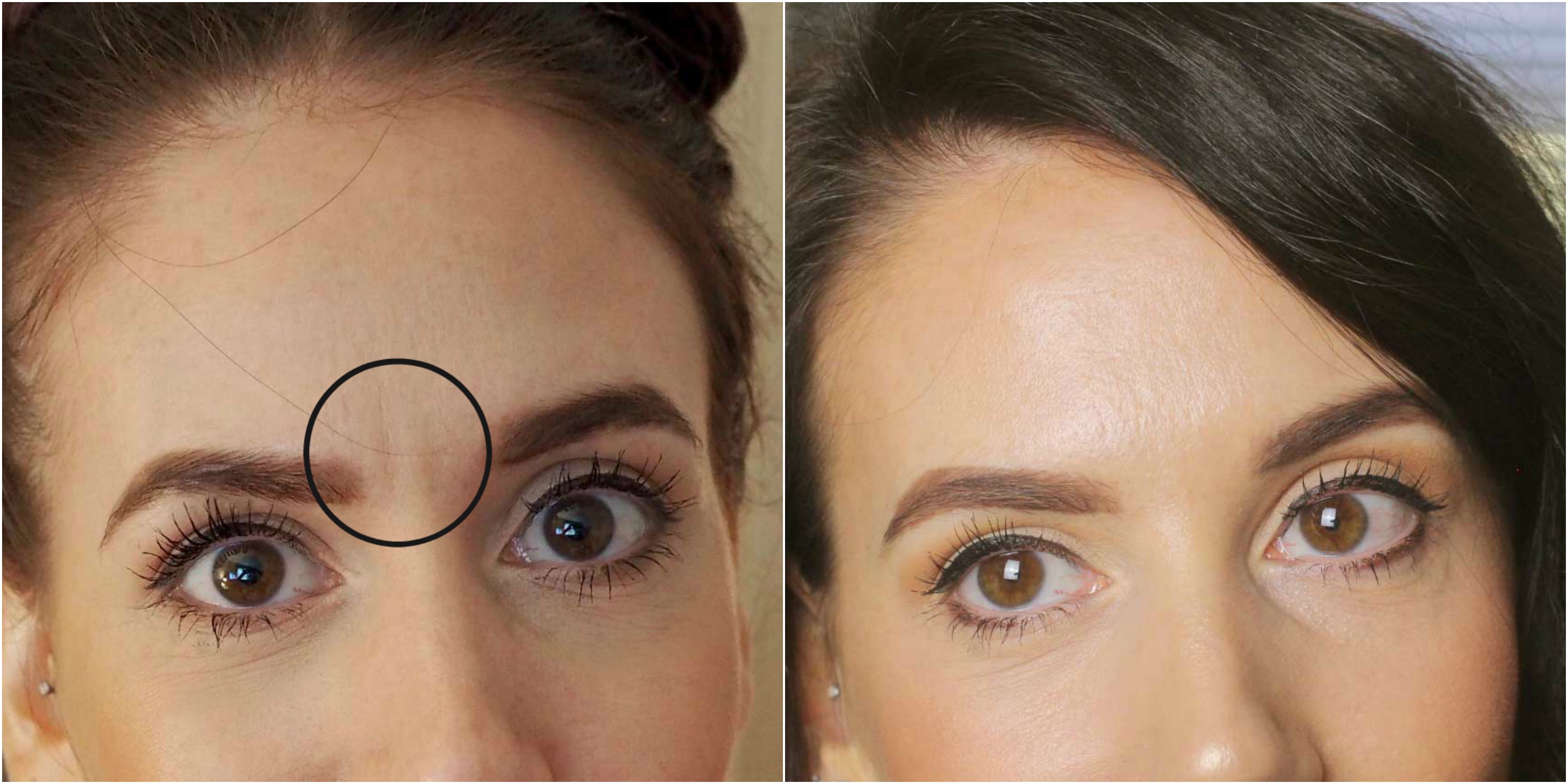 Botox for frown lines | before and after botox frown lines